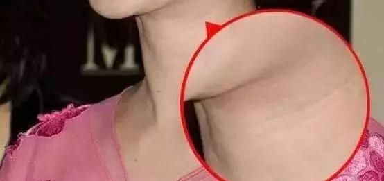 颈部去皱，怎么保养颈部皱纹图3