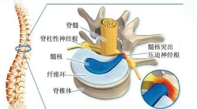 椎间盘膨出治疗方法，腰椎间盘突出症有哪些好的治疗方法图9