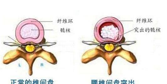 椎间盘膨出治疗方法，腰椎间盘突出症有哪些好的治疗方法图11