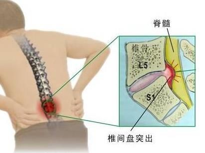 椎间盘膨出治疗方法，腰椎间盘突出症有哪些好的治疗方法图12