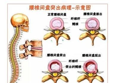 椎间盘膨出治疗方法，腰椎间盘突出症有哪些好的治疗方法图13