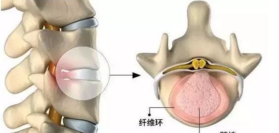 椎间盘膨出治疗方法，腰椎间盘突出症有哪些好的治疗方法图14