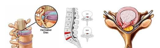 椎间盘膨出治疗方法，腰椎间盘突出症有哪些好的治疗方法图15