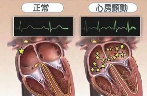 房颤手术图2