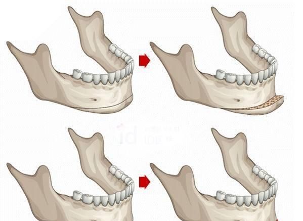 隆下巴费用，做假体下巴有什么副作用吗图1