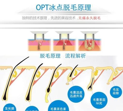 激光脱毛整形，激光脱毛可以保持多久图3