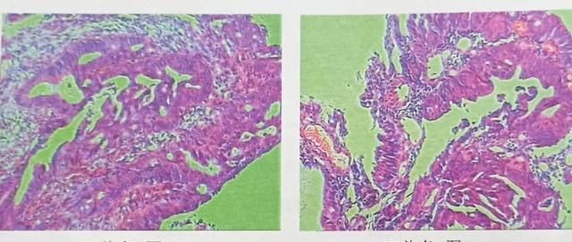 病理切片，直肠癌病理报告免疫组化是什么的图1
