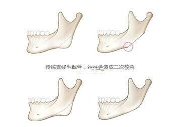 下颌角磨骨手术安全吗图1