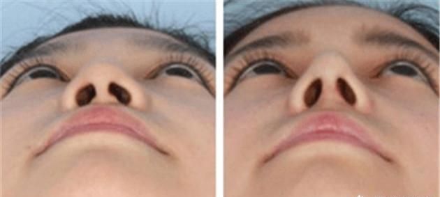 鼻孔缩小是什么原因?图1