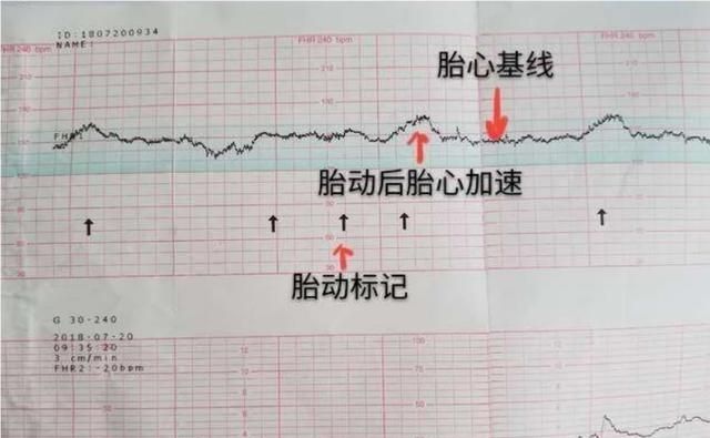 胎心率 性别，胎心快慢和胎儿性别有关系吗图2