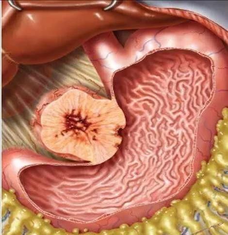 胃间质瘤图1