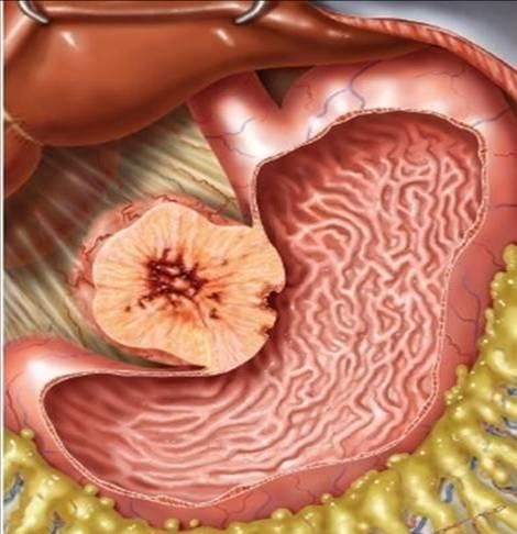 胃间质瘤图2