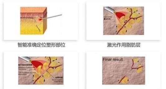 面部太过肥胖的人想要快速瘦脸，应怎么办有些人说激光溶脂可以，是真的吗图3