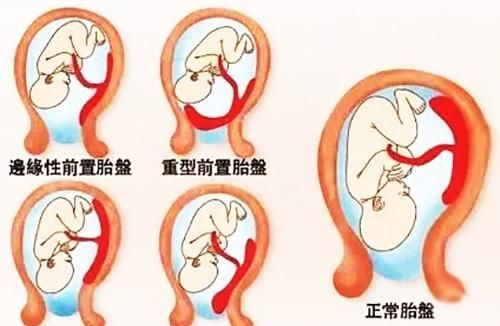 胎盘附于后壁其下缘达至宫颈内口，想知道具体的胎儿图是什么样的图1