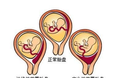 胎盘附于后壁其下缘达至宫颈内口，想知道具体的胎儿图是什么样的图2