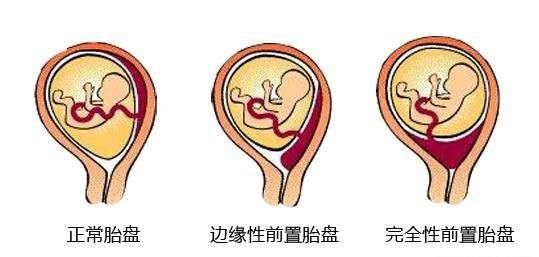 胎盘附于后壁其下缘达至宫颈内口，想知道具体的胎儿图是什么样的图7