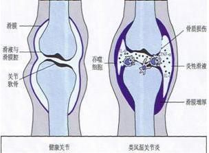 类风湿如何能治好，类风湿应该如何治疗图11