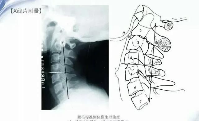 什么样的锻炼对颈椎病有帮助图4