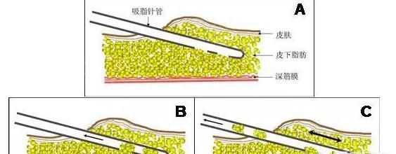 局部吸脂，局部肥胖是否可以通过运动和抽脂结合来解决问题图1
