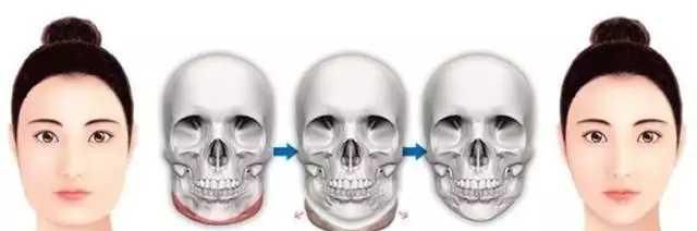 下颌骨磨骨整容图1