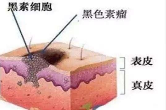 黄褐斑是什么样子图6