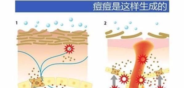 脸上长痘痘怎么办，脸上长痘痘怎么处理图2