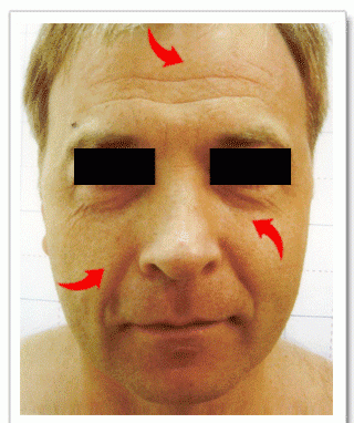 手术拉皮除皱，手术眼部拉皮后为什么还有皱纹呢图1