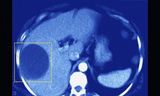 肝囊肿是怎么回事，肝囊肿是怎么形成的图1
