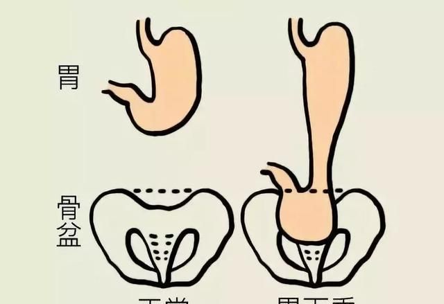 胃下垂康复汤，胃下垂如何治疗图1