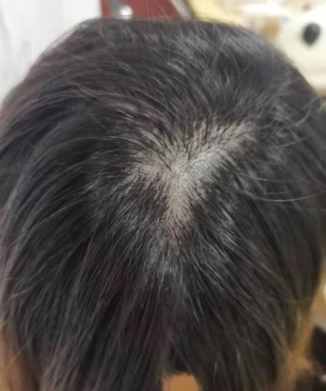 怎么改善油性头发图4