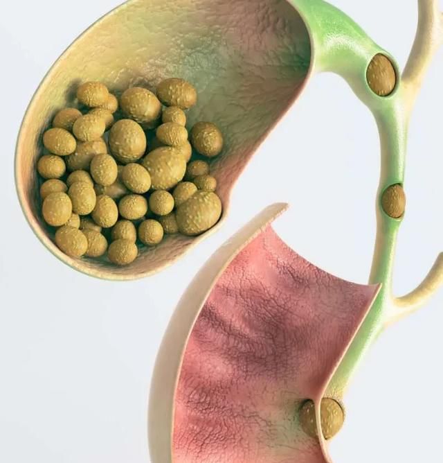 胆结石一定要开刀吗，胆结石手术要切除胆吗图1