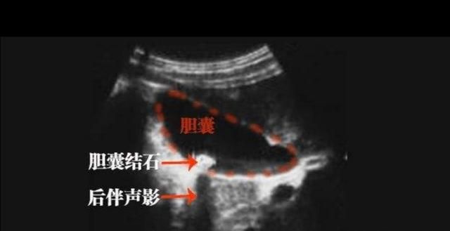 胆结石一定要开刀吗，胆结石手术要切除胆吗图8