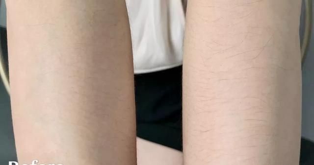 e光脱毛多少钱，脱毛蜜蜡多少钱图34
