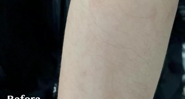 e光脱毛多少钱，脱毛蜜蜡多少钱图49