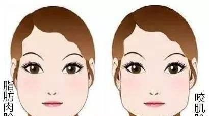 脸瘦咬肌大适合打瘦脸针吗图2