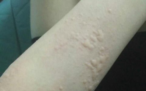 寻麻疹的治疗方法，寻麻疹怎么治疗有效