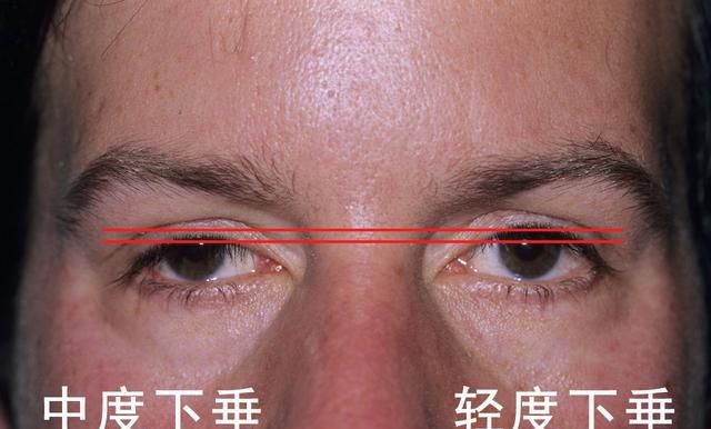 眼睑吸脂，上眼睑下垂怎么矫正图10