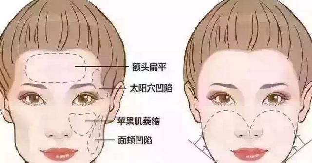 自体脂肪填充下眼睑，自体脂肪填充丰胸安全吗图1