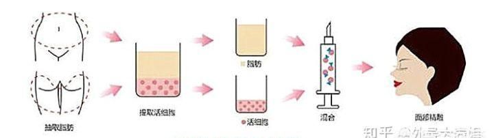 自体脂肪填充下眼睑，自体脂肪填充丰胸安全吗图3