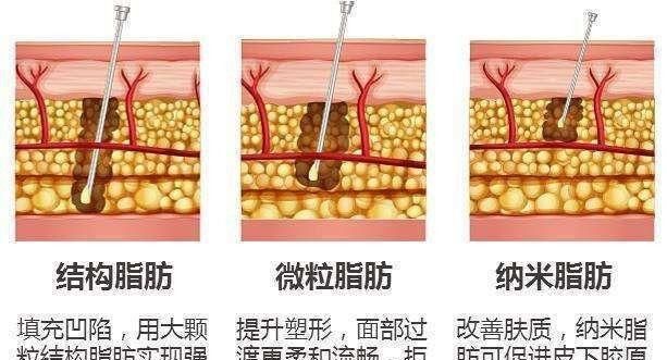 自体脂肪填充下眼睑，自体脂肪填充丰胸安全吗图5