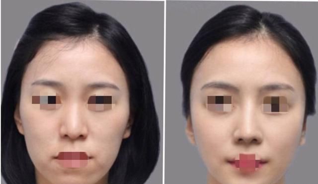 自体脂肪填充下眼睑，自体脂肪填充丰胸安全吗图9