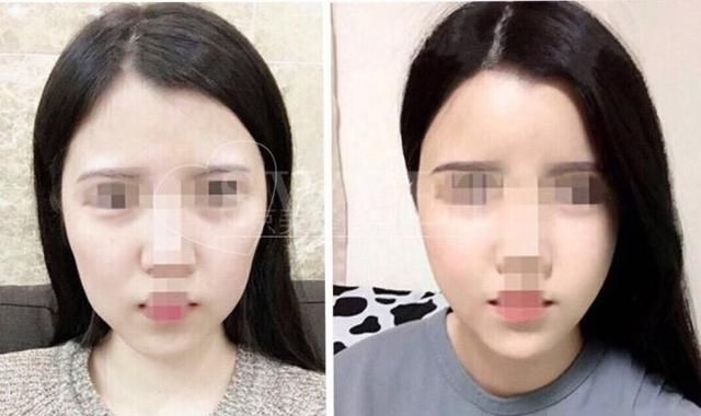 自体脂肪填充下眼睑，自体脂肪填充丰胸安全吗图10