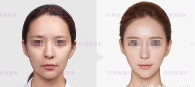 自体脂肪填充下眼睑，自体脂肪填充丰胸安全吗图11