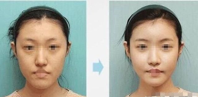 自体脂肪填充下眼睑，自体脂肪填充丰胸安全吗图12