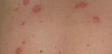 玫瑰糠疹需要忌口的东西图1