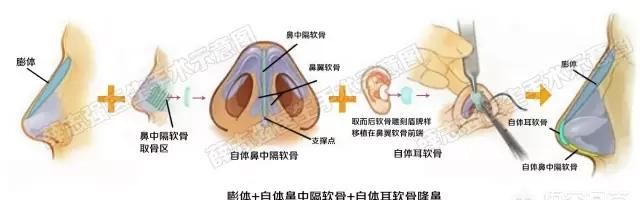 鼻子垫高整形多少钱图6