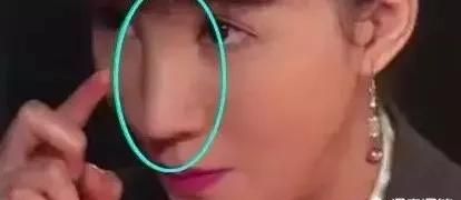鼻子垫高整形多少钱图7