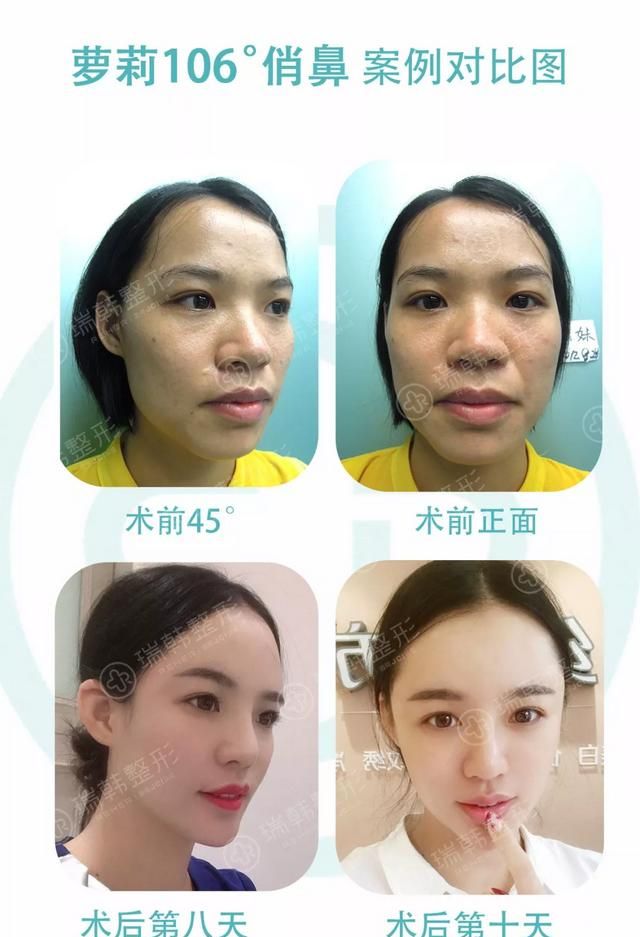 鼻子垫高整形多少钱图8