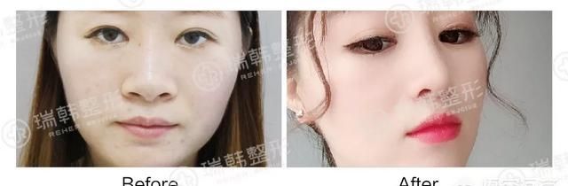 鼻子垫高整形多少钱图9