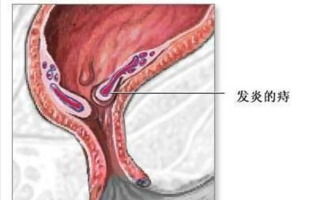 无痛便血，痔疮引起便血怎么办图4